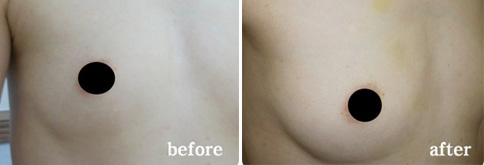 accupuncture needle in breast Accupuncture needle in breast